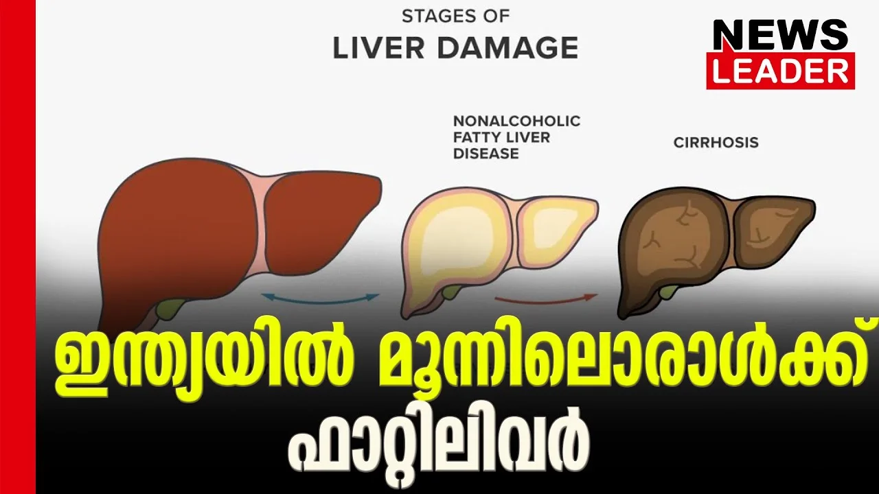 #fattyliver #aiimsdelhi #newsleader #nonalcoholic