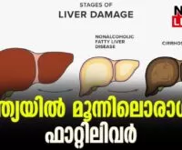 #fattyliver #aiimsdelhi #newsleader #nonalcoholic